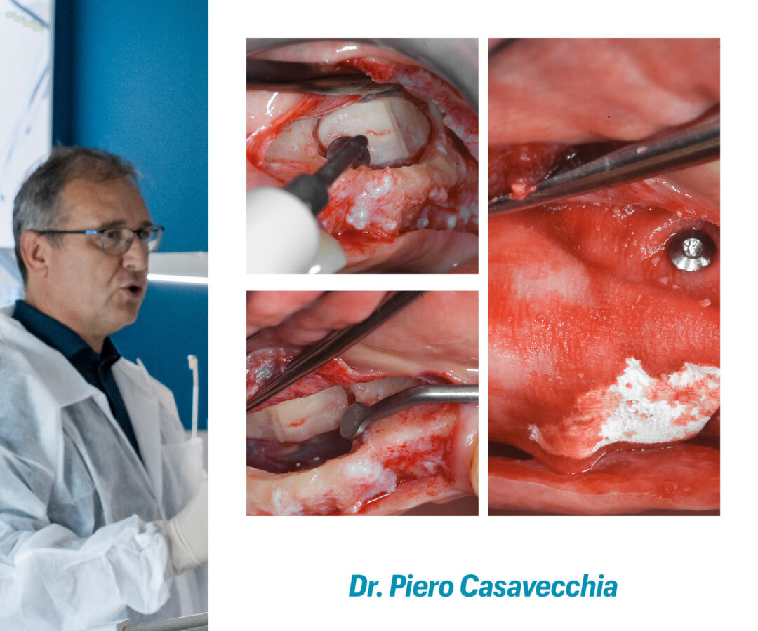 RIALZO DEL SENO MASCELLARE: tecnica crestale e laterale. Gestione delle complicanze