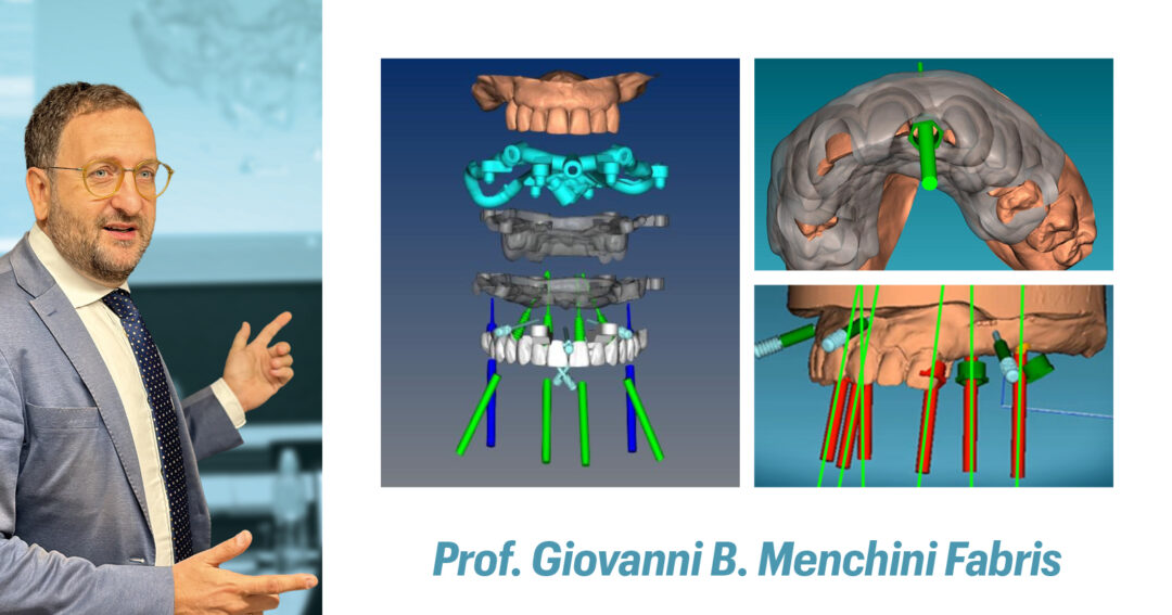 PROGETTAZIONE DELLA DIMA IN CHIRURGIA GUIDATA: aggiornamenti e design