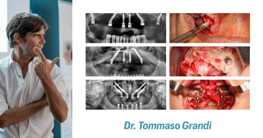 PORTA LE TUE ABILITÀ NEL TRATTAMENTO DEI FULL ARCH AD UN LIVELLO SUCCESSIVO: padroneggia l’estremo con Maxilla-For-All®.