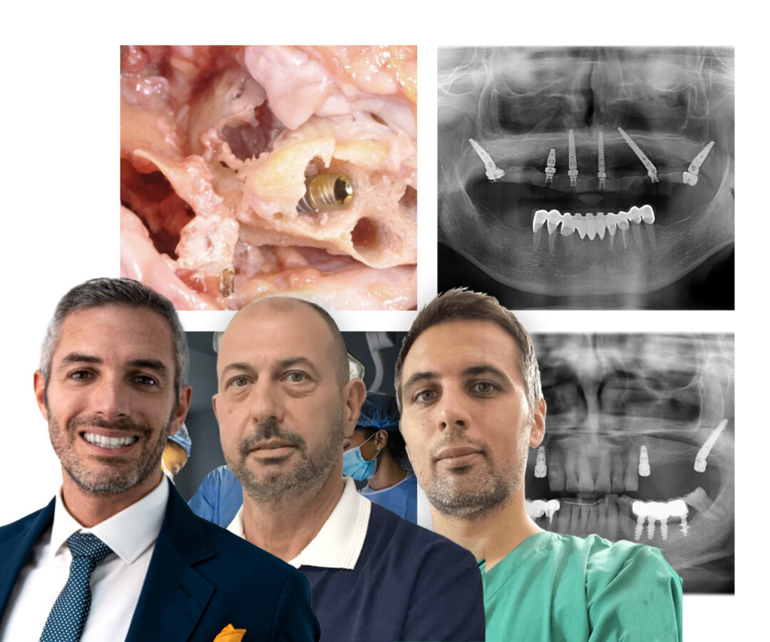 Corso su paziente implantologia full arch e impianti pterigoiedei